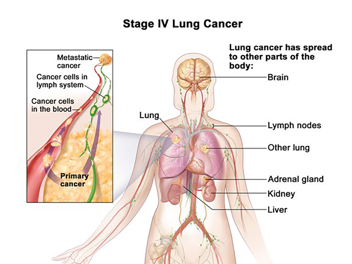 lung cancer cells