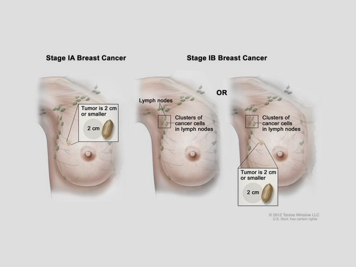 Breast Cancer Stages Stage 0 4 Breast Cancer Osuccc James