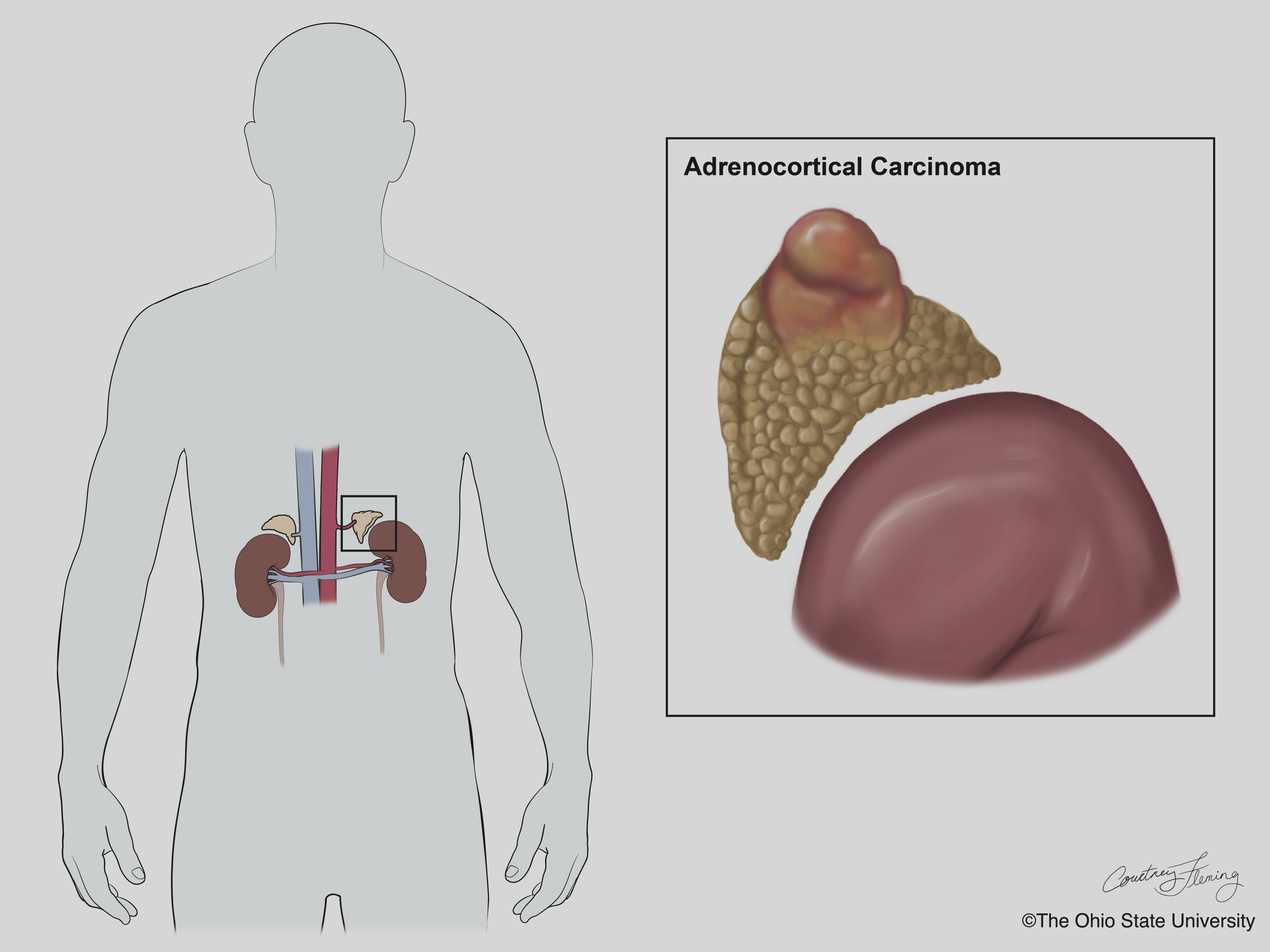 Adrenocortical Cancer (ACC) - INCA