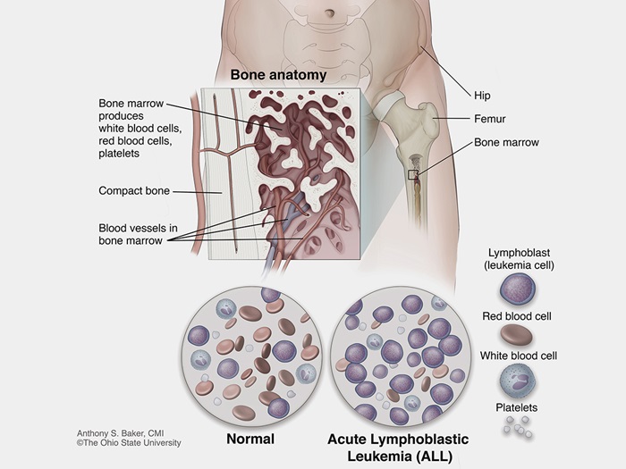 bone marrow diagram leukemia
