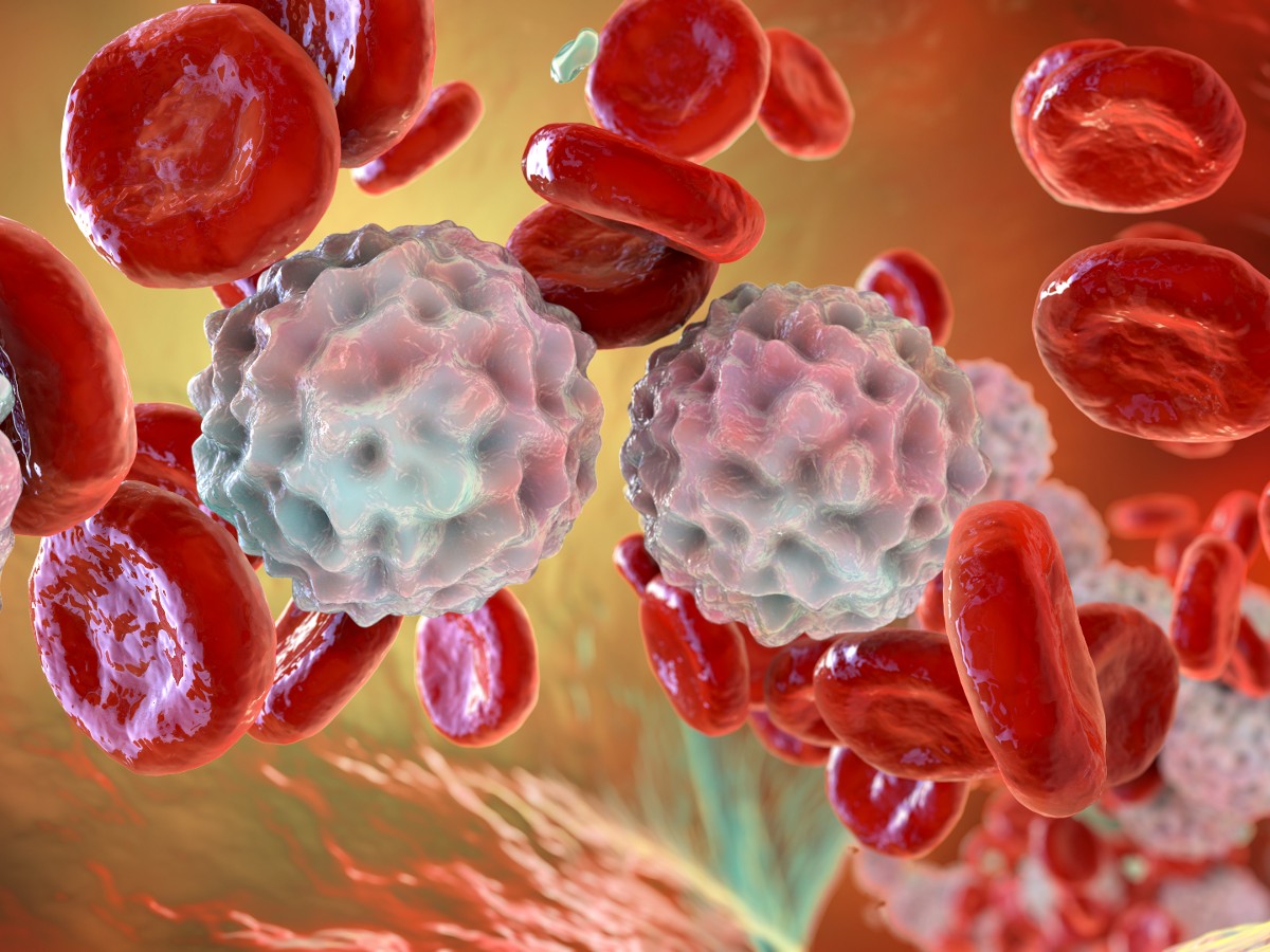 B Cell Acute Lymphoblastic Leukemia | OSUCCC – James