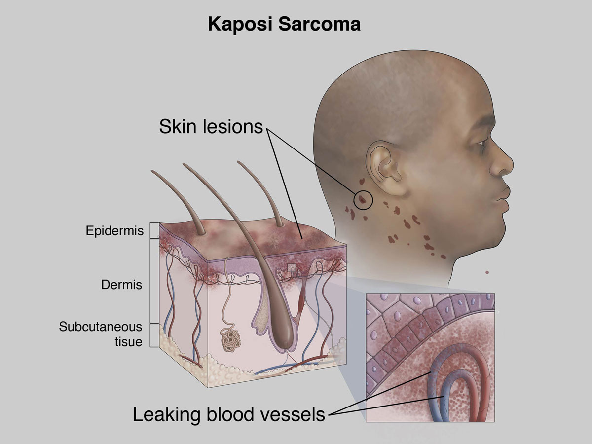 Kaposi Sarcoma | OSUCCC – James