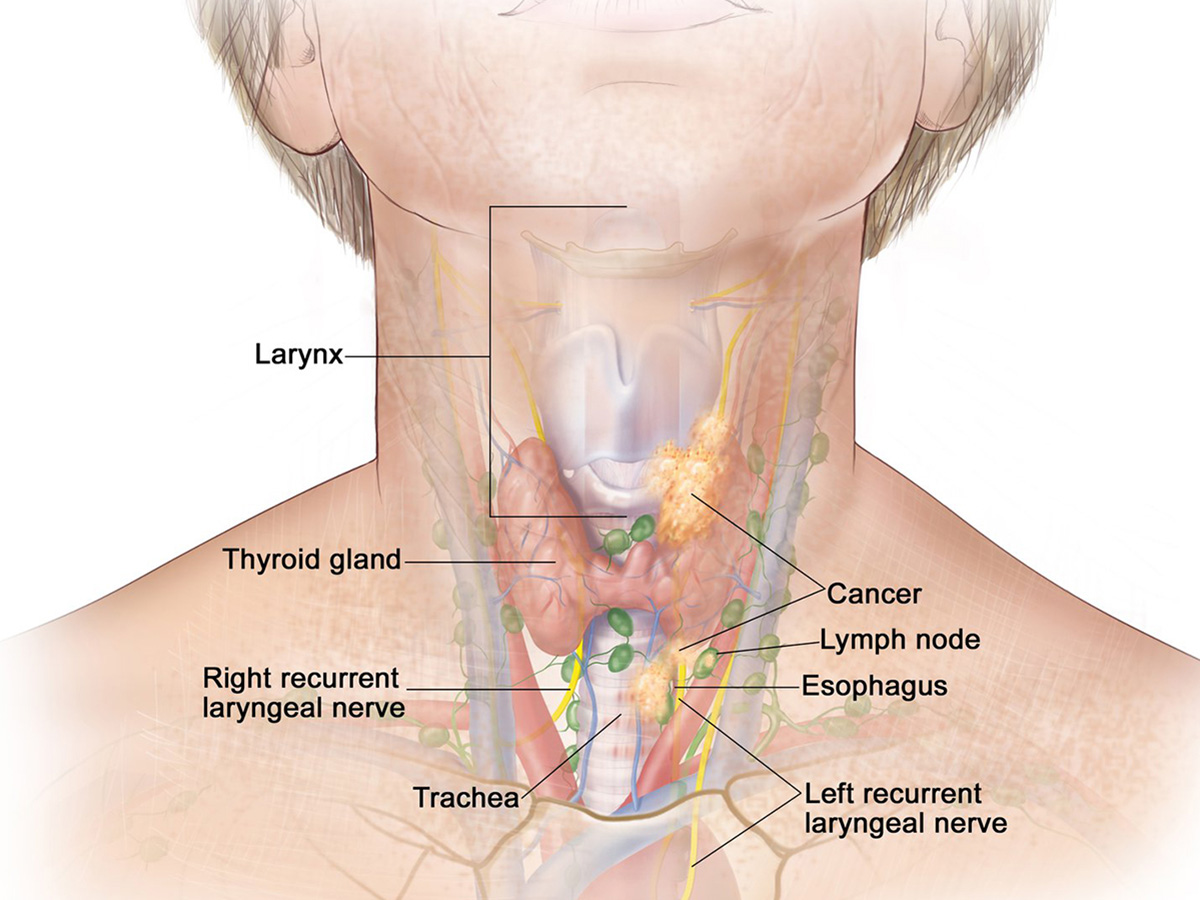 Targeted Therapies Show Initial Effectiveness in Subset of ... lymph node locations diagram 
