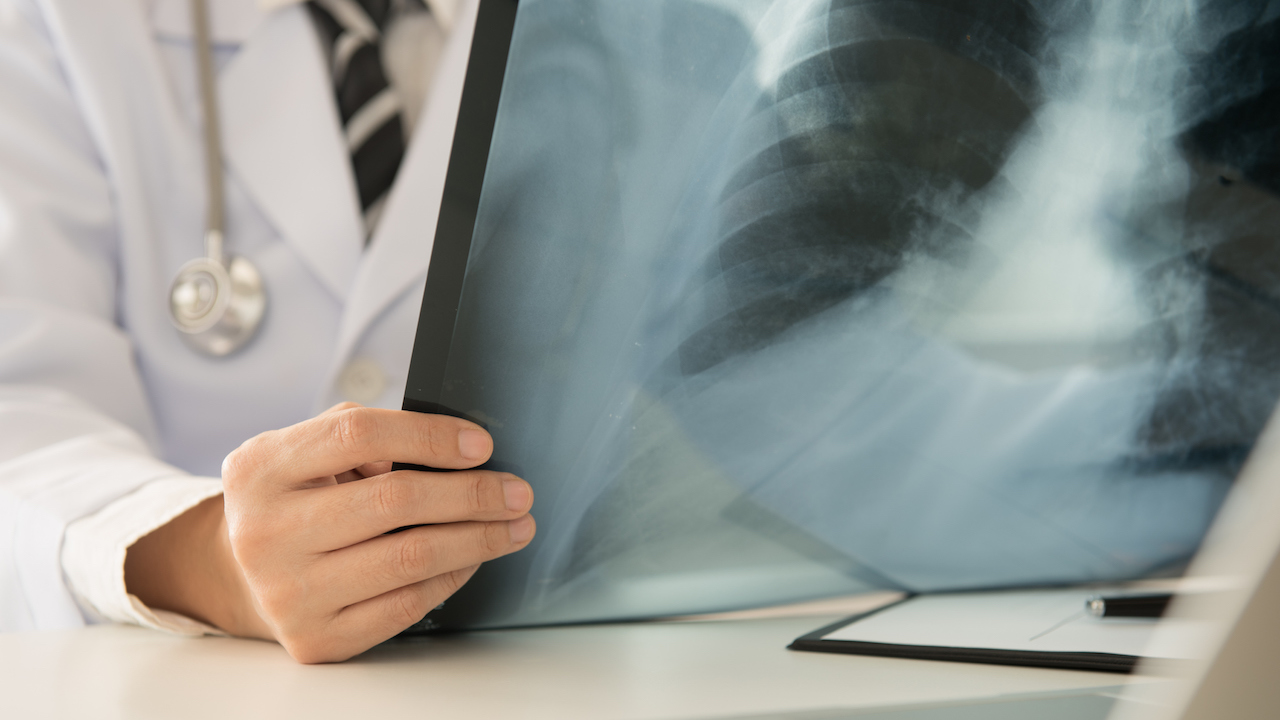 COVID 19 and Cancer: Screening During the Pandemic