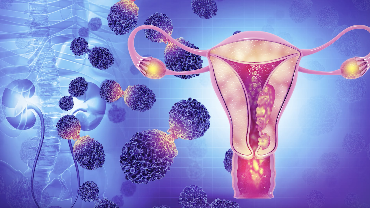 How genetic research could improve immunotherapy for endometrial cancer