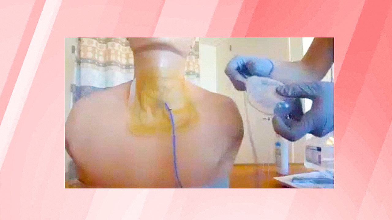 Drain Removed Patients reducing hospitalization time with Ohio State’s home drain ...