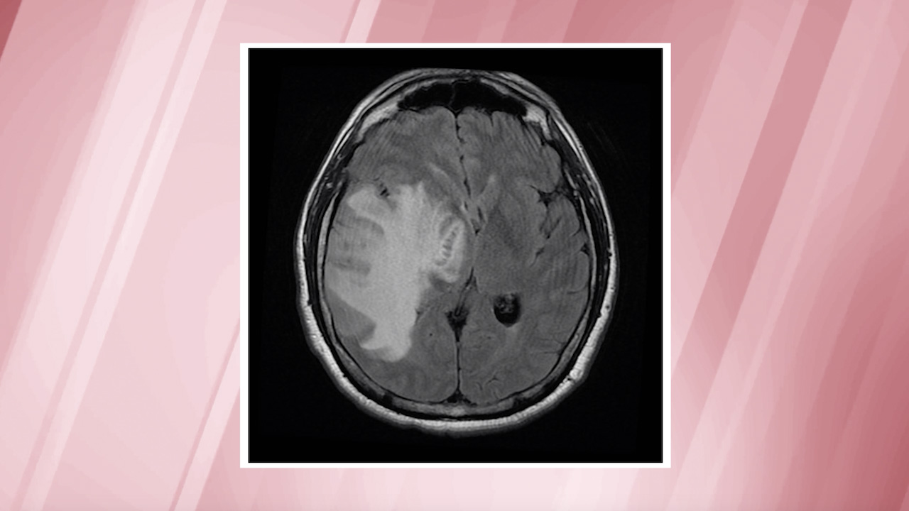 Learn about glioblastoma, the most commonlydiagnosed brain cancer