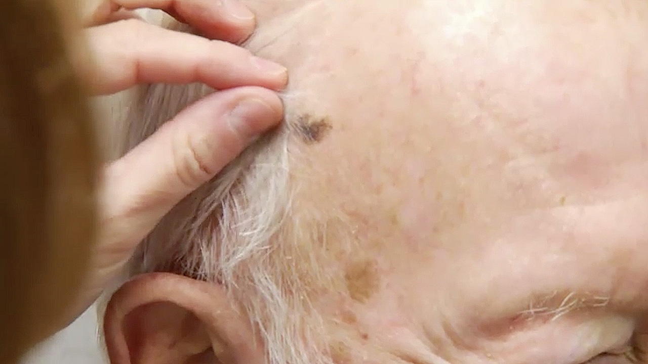 Skin cancer doctors delivering treatments directly into tumors at Ohio